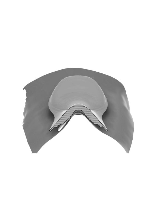 Stirrup Bar Inlays - Narrowing